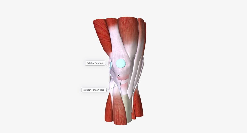 Patellofemoral Pain anatomy knee