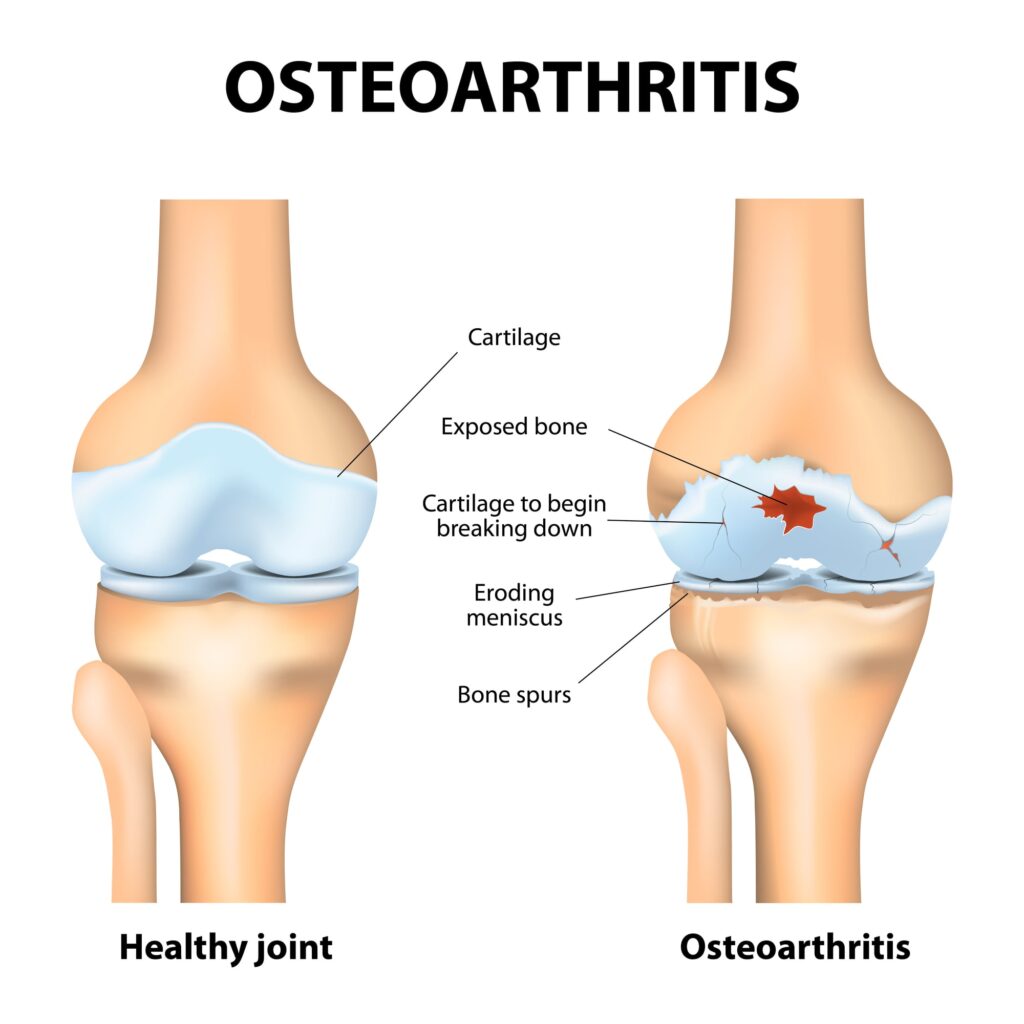 knee arthritis pain hyaluronic acid