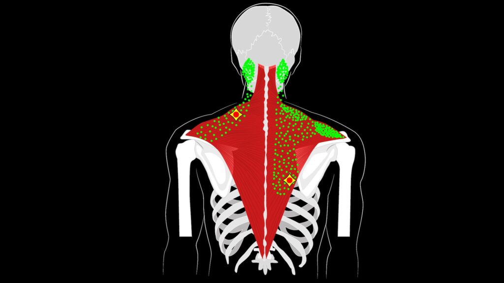 http://musclepain.org/wp-content/uploads/trapezius-muscle-trigger-point-pain-pattern-1024x576.jpg